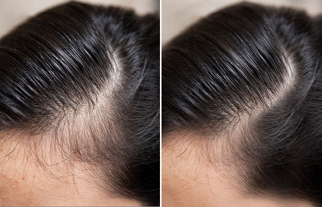 Woman showing comparison of hair part line indicating a symptom of hair thinning